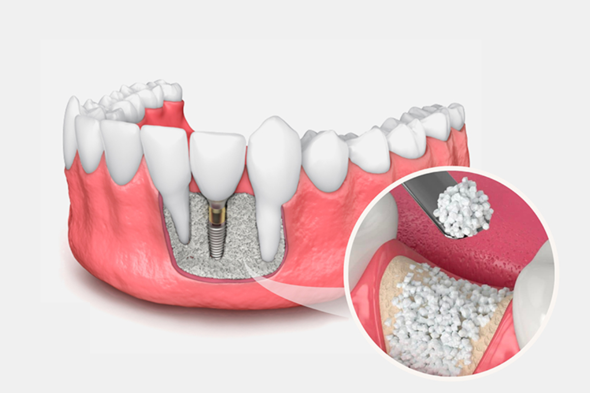 آیا به پیوند استخوان برای ایمپلنت دندان نیاز دارید؟ 1 پیوند استخوان برای ایمپلنت