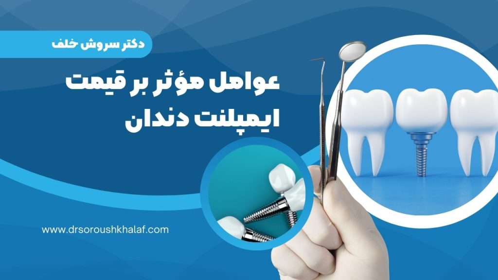 قیمت ایمپلنت دندان