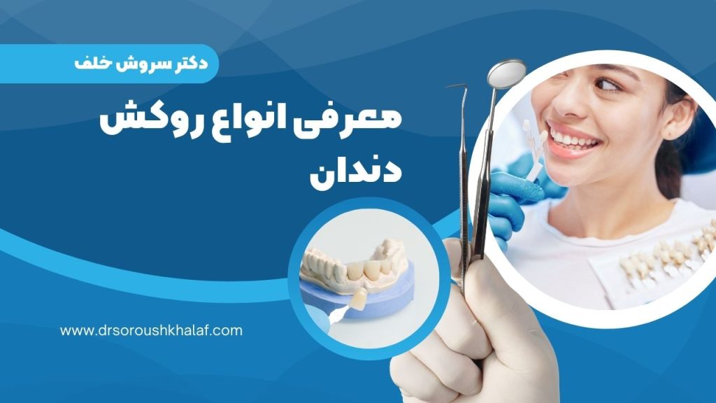 معرفی انواع روکش دندان
