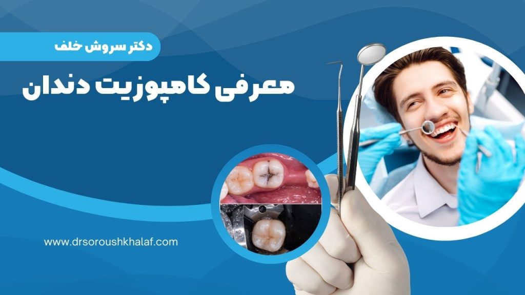 معرفی کامپوزیت دندان