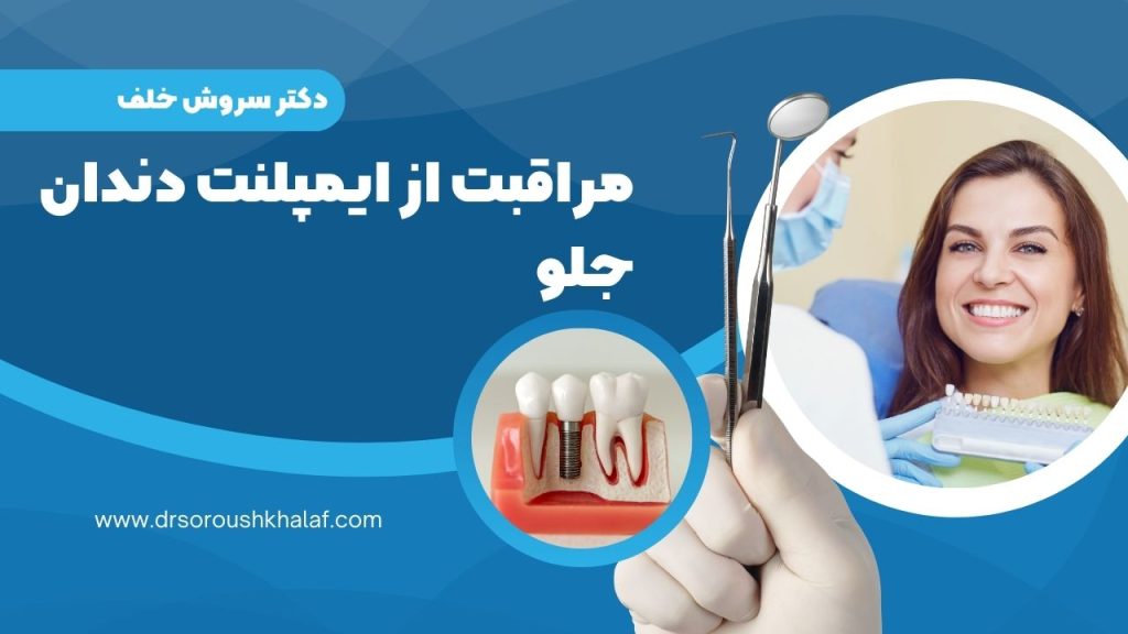 مراقبت از ایمپلنت دندان جلو