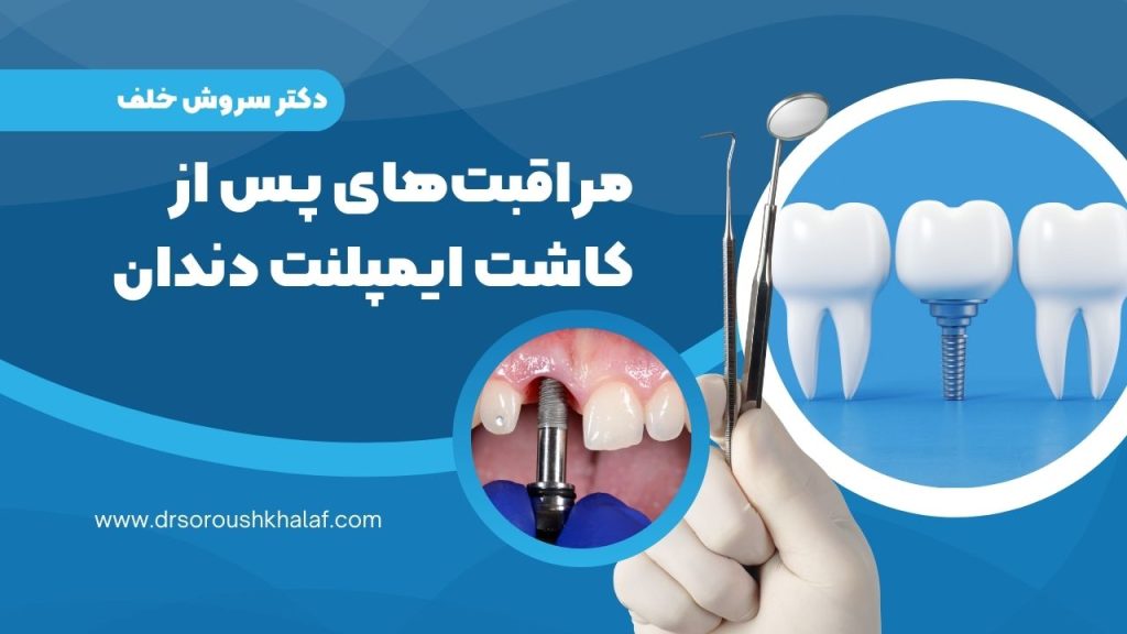 مراقبتهای پس از کاشت ایمپلنت دندان