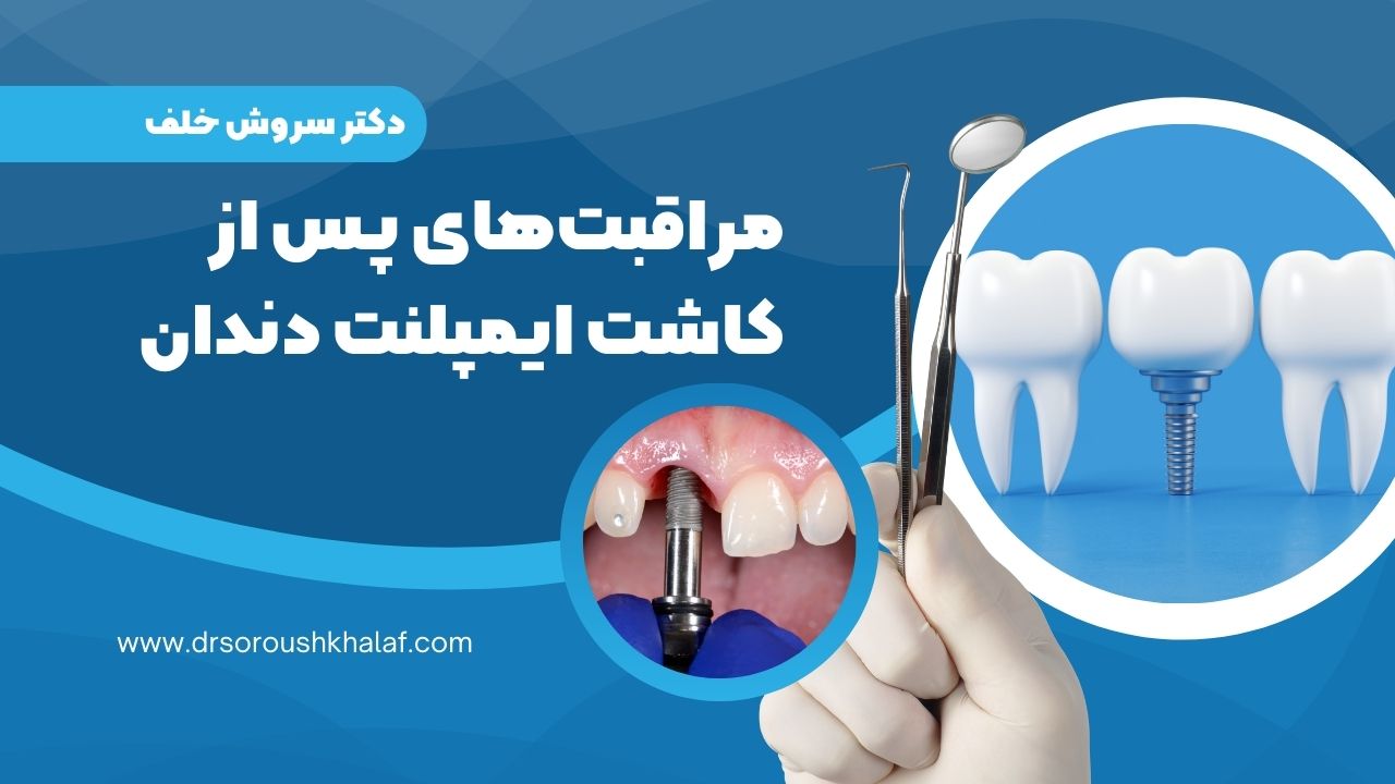 مراقبت پس از کاشت ایمپلنت 1 مراقبتهای پس از کاشت ایمپلنت دندان