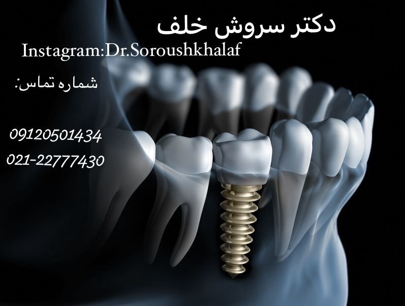 ایمپلنت در بیماران با پیوند عضو33333