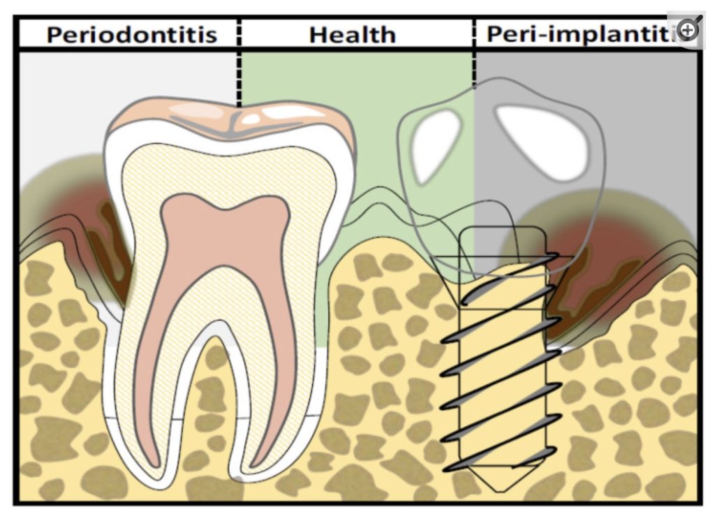 Genotype in dental implant success