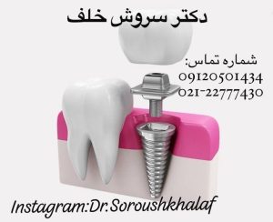 خطرات مصرف مواد محرک بر دوام ایمپلنت دندانی 14