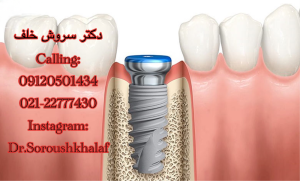 ایمپلنت بدون بخیه