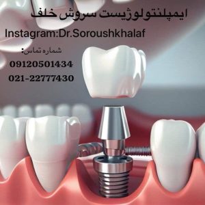 تأثیر زاویه کاشت ایمپلنت