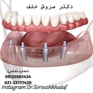 تاثیر ایمپلنت د ر کیفیت زندگی 2 تاثیر ایمپلنت د ر کیفیت زندگی
