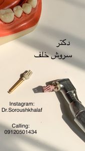 اهمیت آنالیز بایت پیش از کاشت ایمپلنت 2 آنالیز بایت پیش از کاشت ایمپلنت
