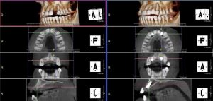 اهمیت CBCT در تشخیص قبل از ایمپلنت
