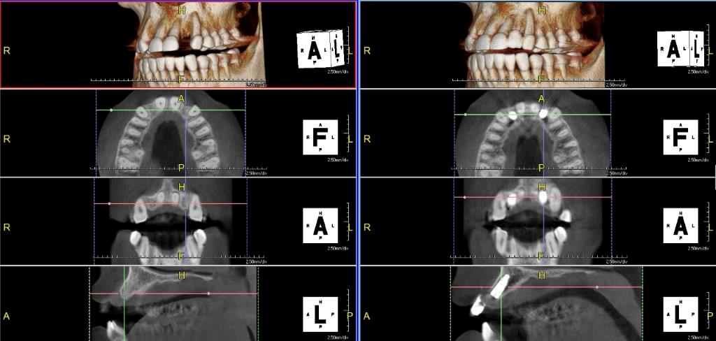 اهمیت CBCT در تشخیص قبل از ایمپلنت