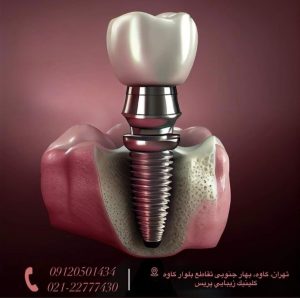 اهمیت CBCT در تشخیص قبل از ایمپلنت