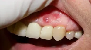 گوشت اضافه لثه