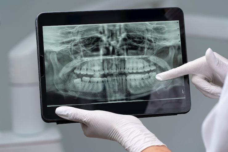 چرا برای کاشت ایمپلنت دندان به تصویربرداری CBCT نیاز داریم؟