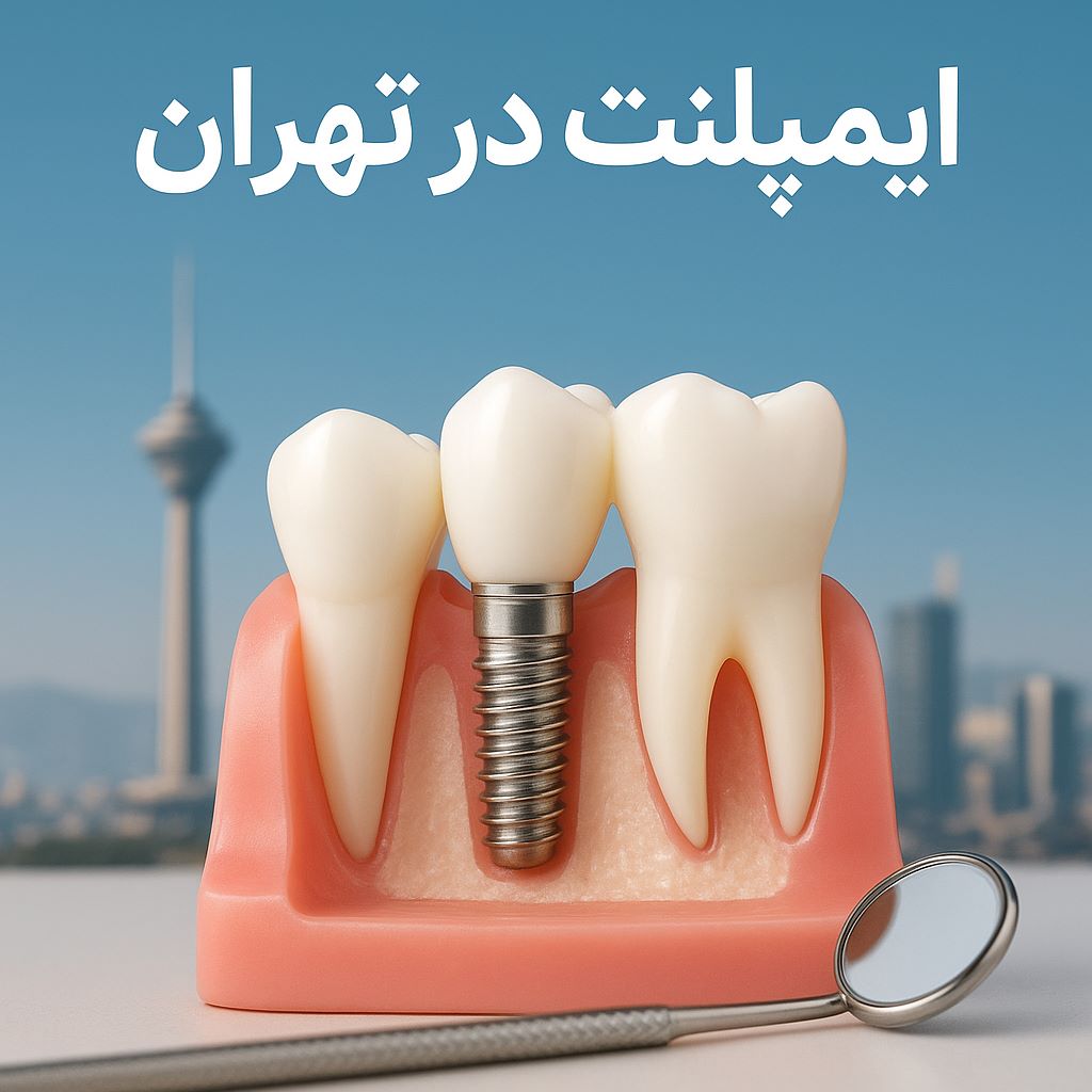 ایمپلنت در تهران