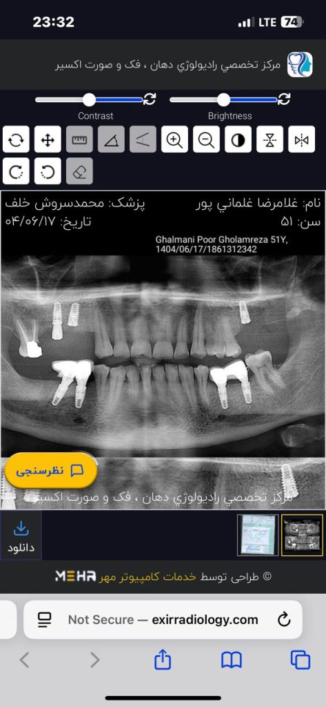 ایمپلنت