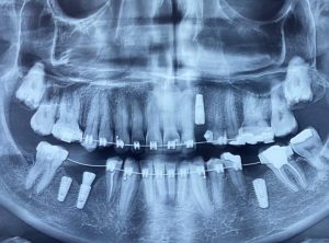https://drsoroushkhalaf.com/immediate-implant/