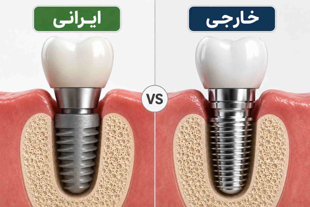 ایمپلنت ایرانی یا خارجی؟