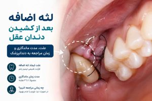 گوشت اضافه بعد از کشیدن دندان عقل