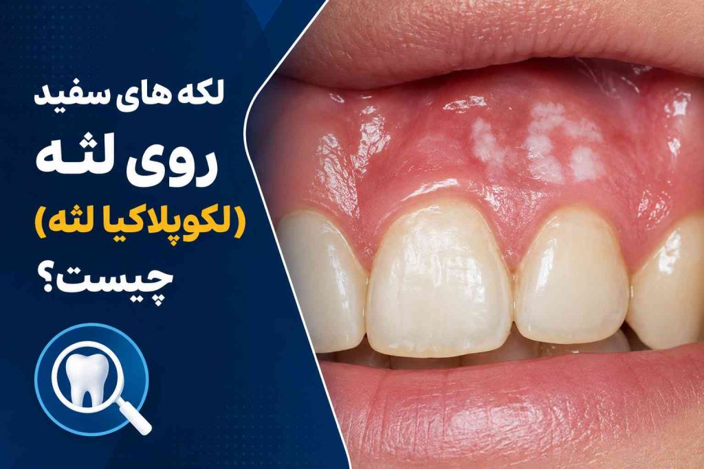 لکه های سفید روی لثه(لکوپلاکیا لثه) چیست؟