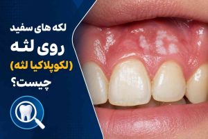لکه های سفید روی لثه(لکوپلاکیا لثه) چیست؟