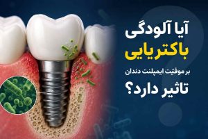 آیا آلودگی باکتریایی بر موفقیت ایمپلنت دندان تاثیر دارد؟