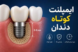 نقش ایمپلنت‌ های کوتاه در دندانپزشکی مدرن