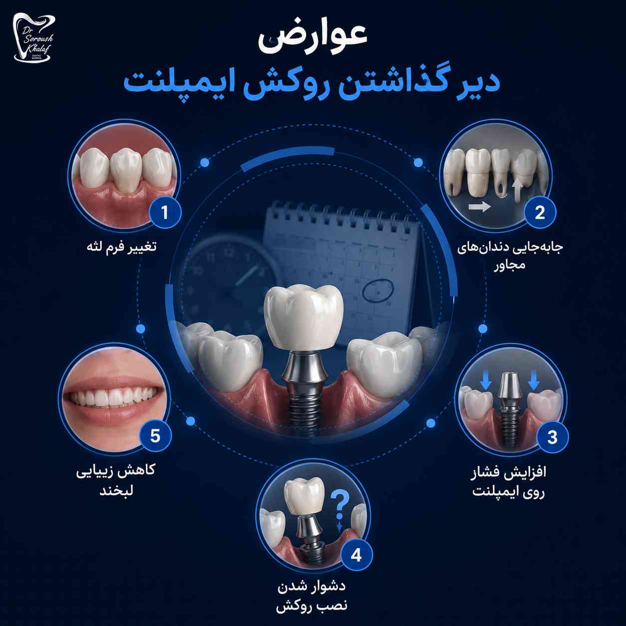 عوارض دیر گذاشتن روکش ایمپلنت