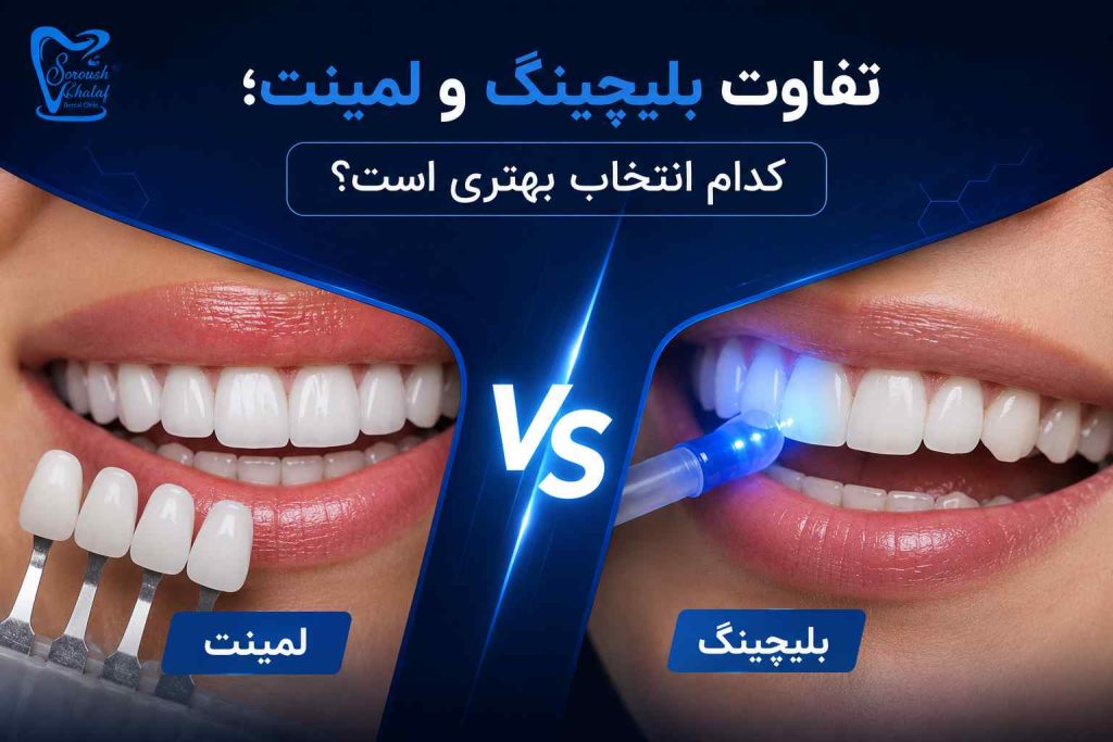 بلیچینگ دندان