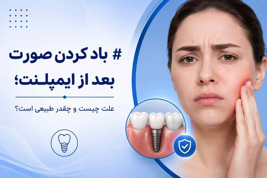 ایمپلنت