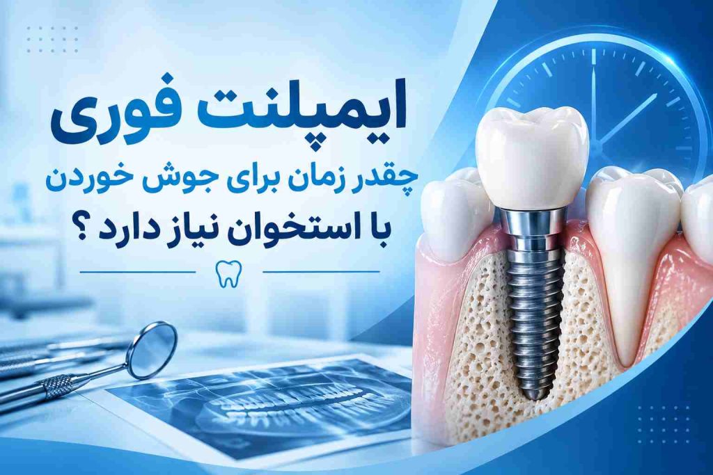 ایمپلنت فوری در تهران